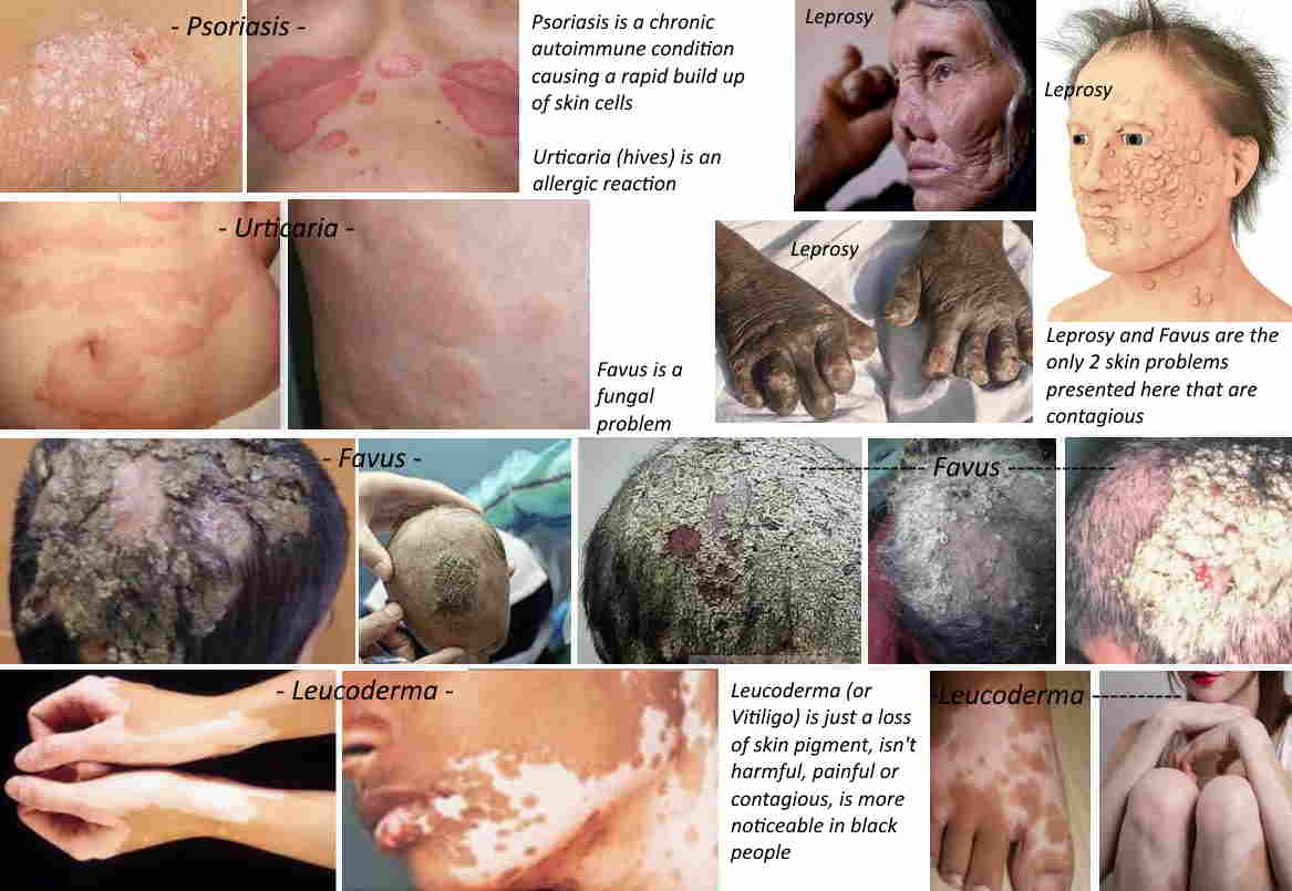 numerous pictures showing examples of psoriasis, urticaria, favus, leucoderma and leprosy